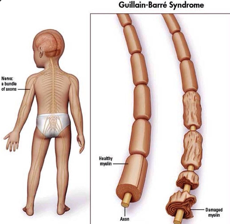 Guillain-Barré Syndrome